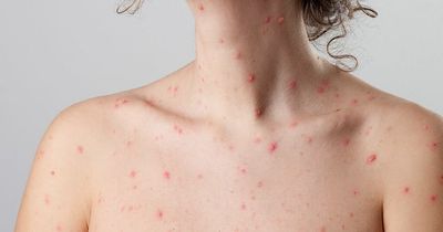The symptoms of monkeypox and chickenpox and how to spot the difference