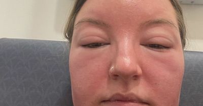 Woman awakes to find her face had doubled in size ‘due to sun poisoning’