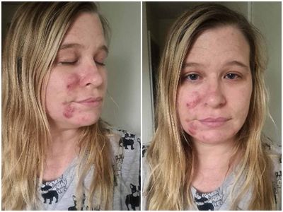 Woman hails £85 skincare kit as ‘miracle cure’ for her cystic acne