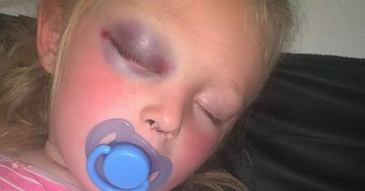 Three-year-old girl 'lucky to be alive' after fall from scooter leaves her with multiple fractures to skull