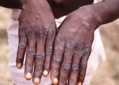 WHO: Monkeypox caused no deaths in Europe so far