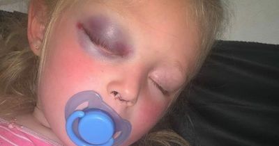 Mum's warning as girl, 3, suffers bleed on brain after falling from scooter