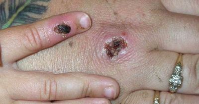 Monkeypox lesions explained as expert warns they can scar the body