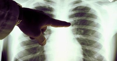 Don't delay seeing doctor if you have lung cancer symptoms - it could save your life