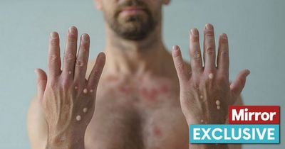 Monkeypox: Expert reveals all you need to know as virus declared global health emergency