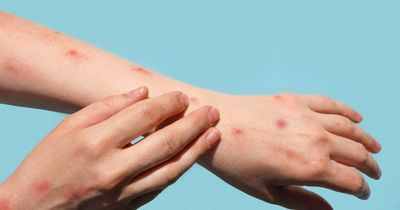 First person in Europe dies after catching monkeypox since start of current outbreak