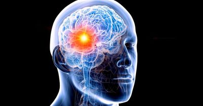 The subtle signs of a potential brain tumour from personality changes to headaches