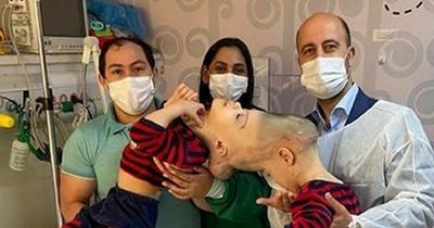 UK surgeon successfully separates twins who were joined at the head
