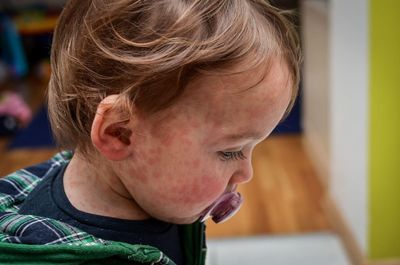 Audit finds variation in children’s allergy services across the UK