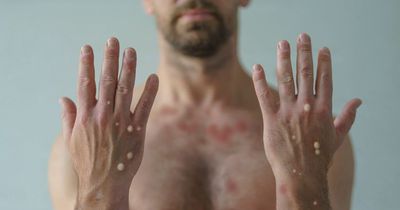 New monkeypox skin symptom identified in new study is 'clear sign' of virus as cases rise
