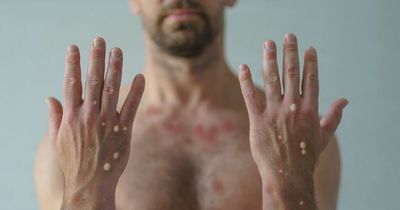 New monkeypox symptoms identified - pseudo-pustules that lead to ulcers
