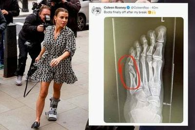 Coleen Rooney shares X-ray of broken foot after Rebekah Vardy suggests she was ‘milking’ injury in court