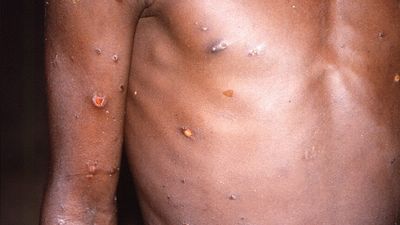 Third-generation monkeypox vaccines secured, with gay and bisexual men in 'high-risk' categories targeted for first rollout