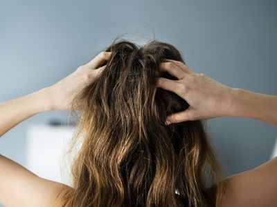 Hair expert warns against viral anti-dandruff TikTok trend that could ‘cause chemical burn’