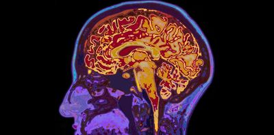 'Brain fingerprinting' of adolescents might be able to predict mental health problems down the line