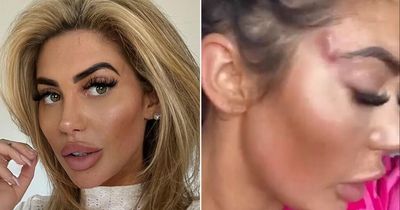 Chloe Ferry shares butchered face after fox eye surgery left gaping holes in her skin