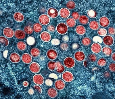 UK: 'Early signs' that monkeypox outbreak may be peaking