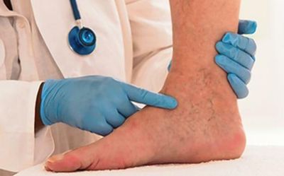 Vascular diseases on the rise, but surgeons too few, says Health Minister