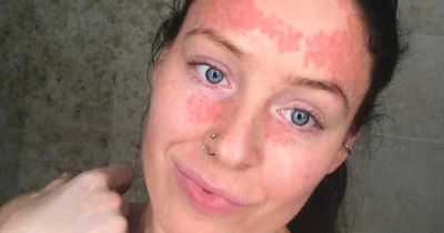 Woman says 70% of her body is covered in red marks due to rare condition