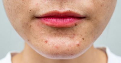 3 monkeypox symptoms found on the face - 'pimples' to lesions in mouth and throat