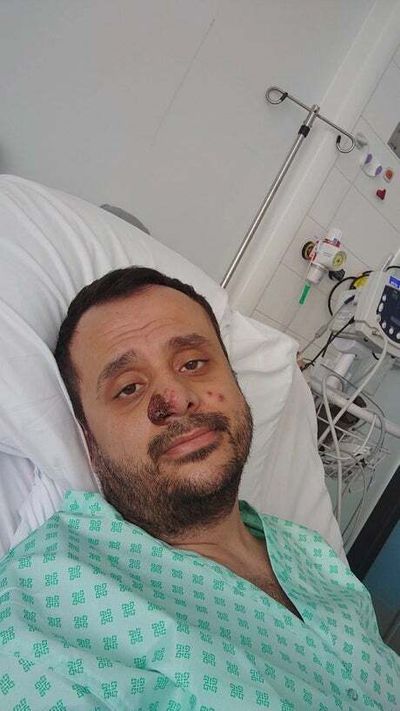 Londoner tells of agony after being hospitalised with severe case of monkeypox