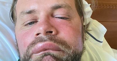 Brian McFadden rushed to doctors with severely swollen face after allergic reaction