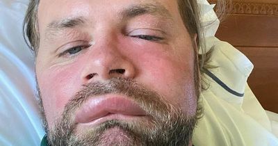 Westlife singer Brian McFadden suffers allergic reaction