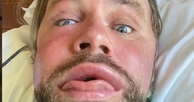 Brian McFadden says 'face is calming down' after alarming fans with bee sting video