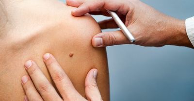 Skin cancer symptoms - how to spot squamous cell carcinoma