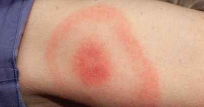 Is it Covid or Lyme disease? Key symptom to spot as infections cause similar signs