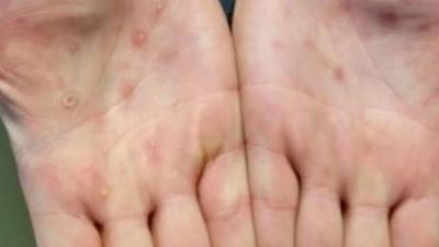 South Australia records second case of monkeypox, SA Health says