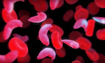 Sickle cell disease: nearly 50% of patients receive poor care, says global study