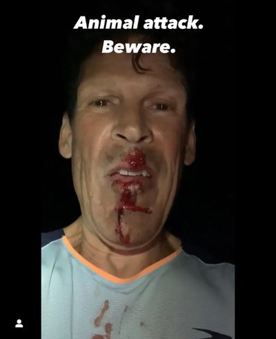 Bloodied ultramarathon runner shares video moments after he was attacked by a coyote on a 150-mile run