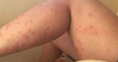 Woman's 'bedbug nightmare' on holiday with people 'too scared' to use pool with her