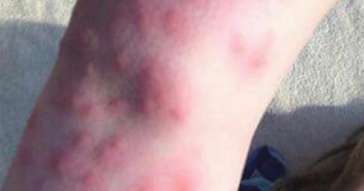 Woman's body covered in painful bedbugs during two-week holiday hell