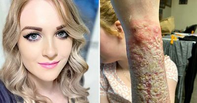 Venomous spider bite left mum unable to cuddle kids and at risk of cancer