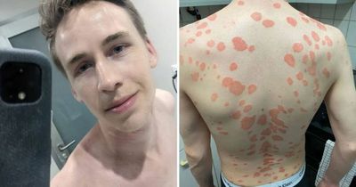 Man who ‘became a hermit’ after waking up covered in drop-shaped sores is ‘sassy’ again after drastic lifestyle change