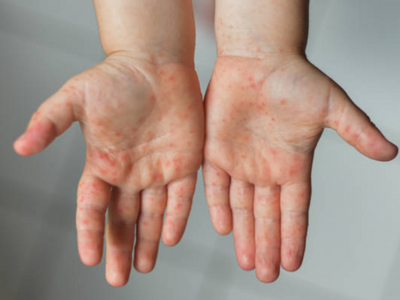 Tomato fever in kids: Symptoms that tend to confuse parents