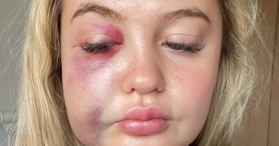 West Lothian mum hopes social media will help find gang who beat her daughter black and blue on night out