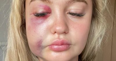 Woman beaten black and blue and left unconscious by strangers on birthday night out