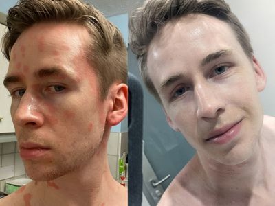 Man credits diet change and £19.99 skin cream for treating his psoriasis - OLD