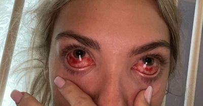 Woman looked 'like a zombie' after extreme reaction to lash extensions sealed eyes shut