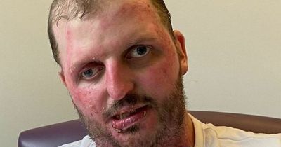 Big Jeff shares fresh image of serious burns sustained in house fire