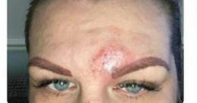 Woman's warning over viral TikTok health trend that 'cut open' her head
