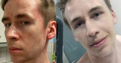Man who 'became hermit' due to severe skin condition cures it thanks to £20 cream