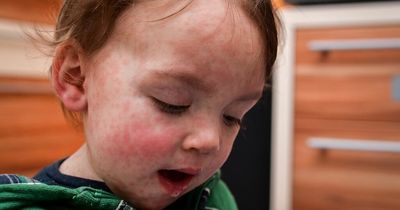 HSE warn of measles symptoms and risks as 'worrying' drop in children's vaccination rates seen