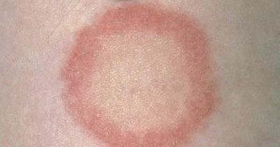 HSE issue ringworm warning to Irish public and common symptoms you should seek help with