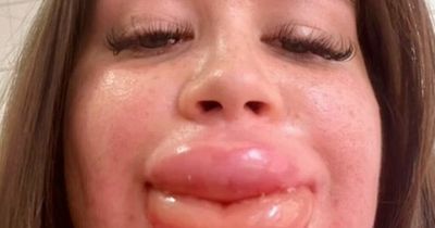 Woman warns against dissolving lip filler as severe reaction causes her pout to balloon