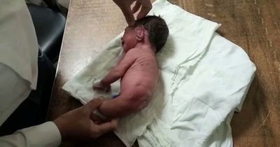 Doctors stunned after a baby is born with a horn-like structure instead of legs
