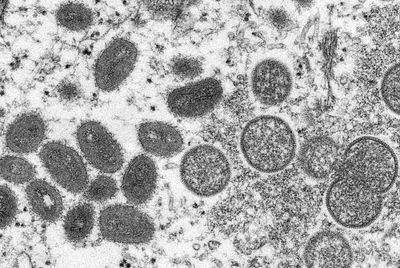 Harris County resident with monkeypox dies, marking first death in the U.S. linked to the virus